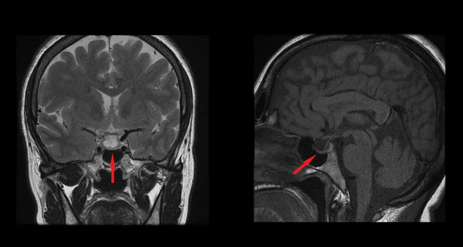 Pituitary Gland Hypophysis MRI Scan (Magnetic Resonance Imaging) – anatomy of human brain